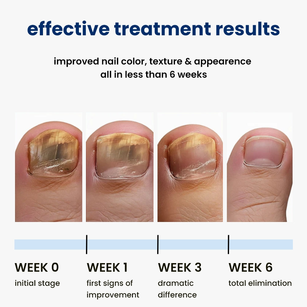 nightime antifungal nail patches