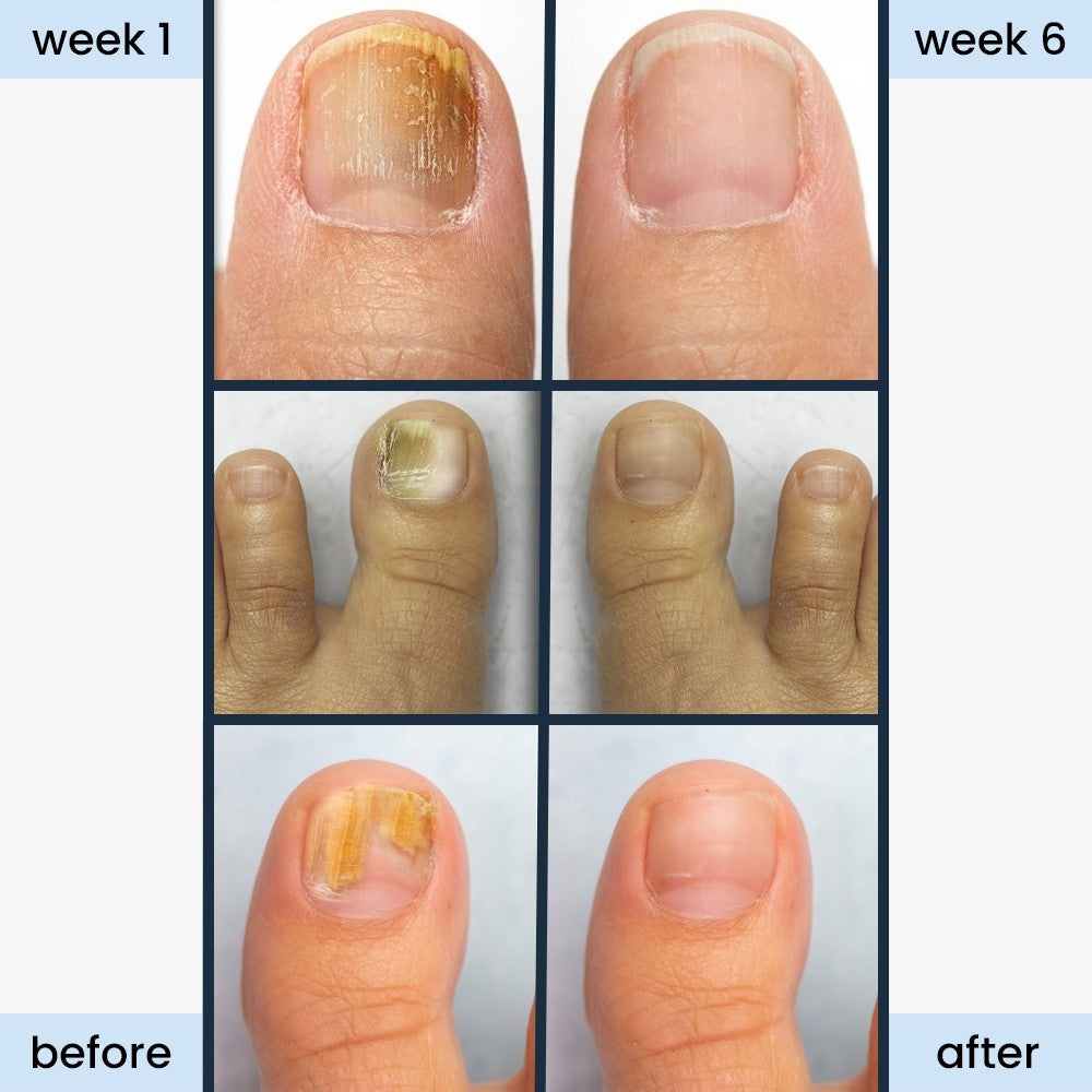 nightime antifungal nail patches