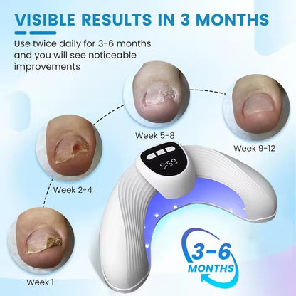 Nail fungal laser treatment