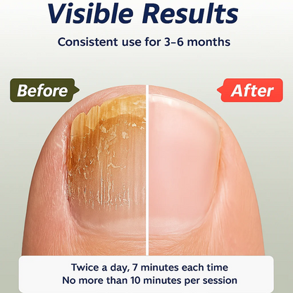 Nail fungal laser treatment